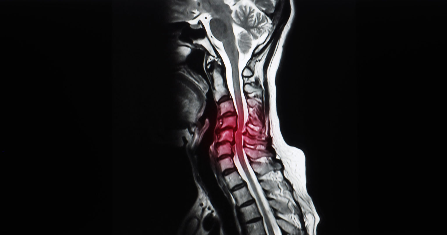 Stenosis of the cervical canal and myelopathy Dr François LECHANOINE