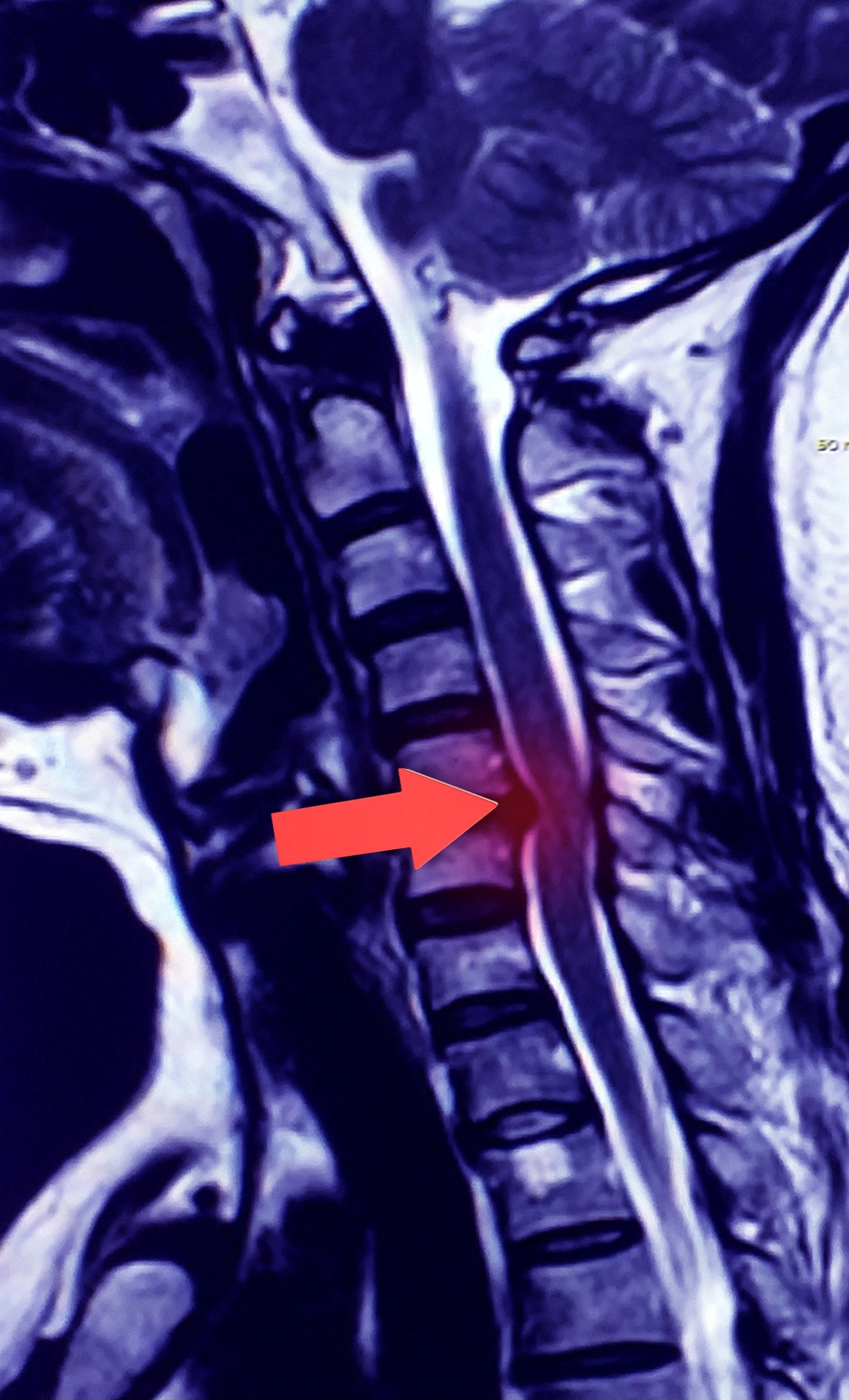 Ernia Cervicale E Cervicobrachialgia Dott Fran Ois Lechanoine