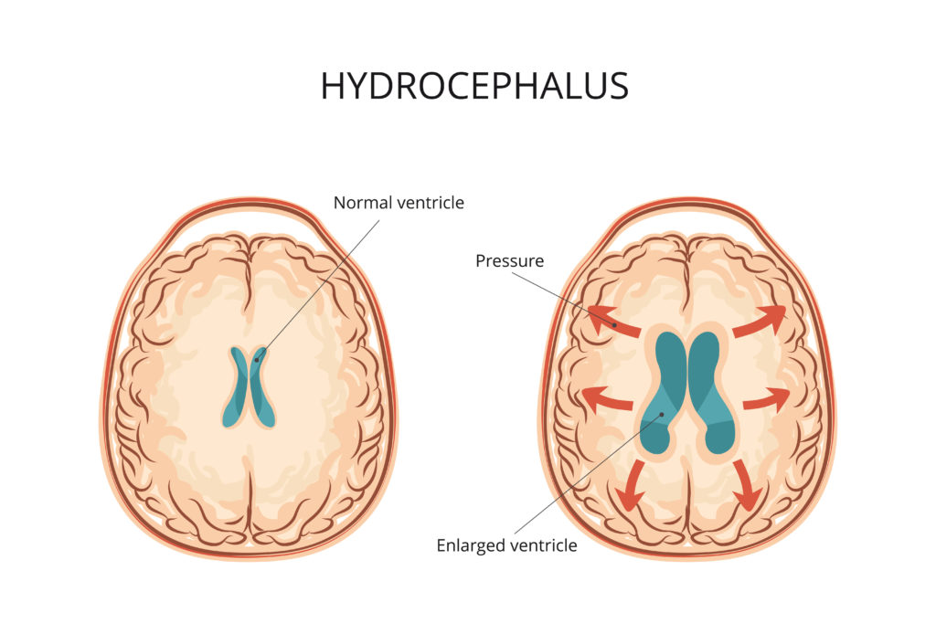 hydrocephalus with ventricular dilation