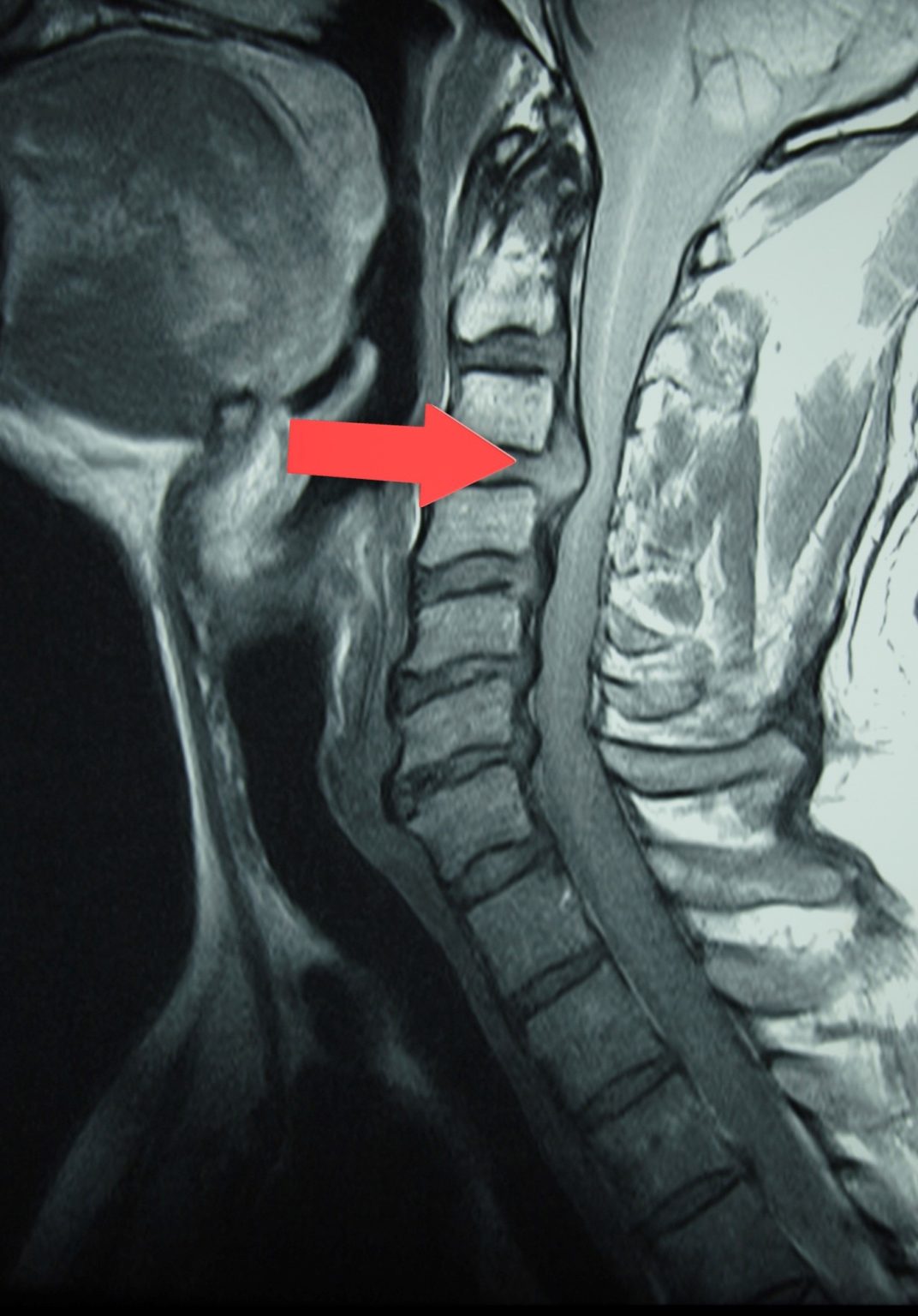 Ernia cervicale e cervicobrachialgia - Dott. François LECHANOINE