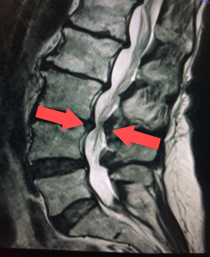 Stenosis of the lumbar canal