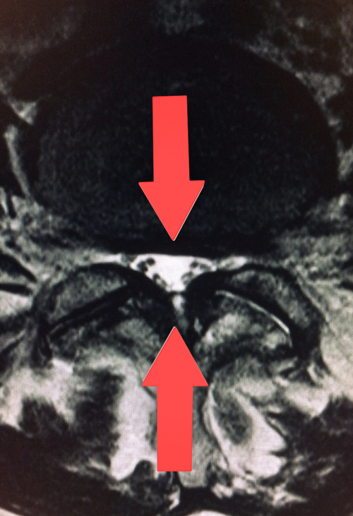 Stenosis of the lumbar canal